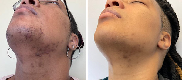 Patient face, before and laser skin resurfacing treatment, set 1, patient 2