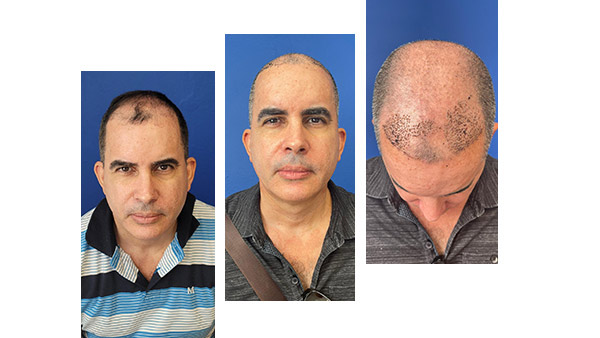 Hair restoration patient before and after photo 1