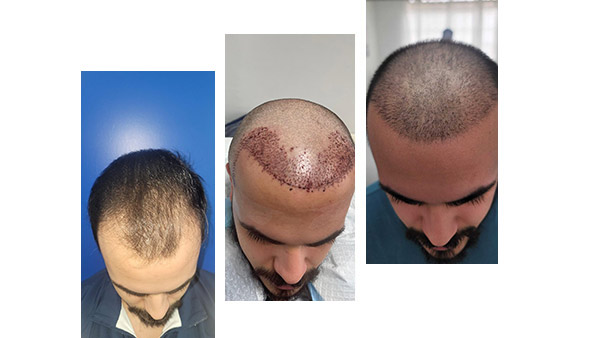 Hair restoration patient before and after photo 2