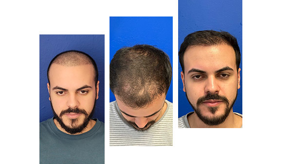 Hair restoration patient before and after photo 3