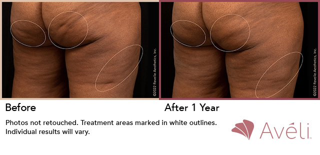 Female patient, before and 1 year after Cellulite Reduction treatment - patient 1