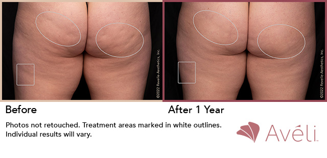 Female patient, before and 1 year after Cellulite Reduction treatment - patient 2